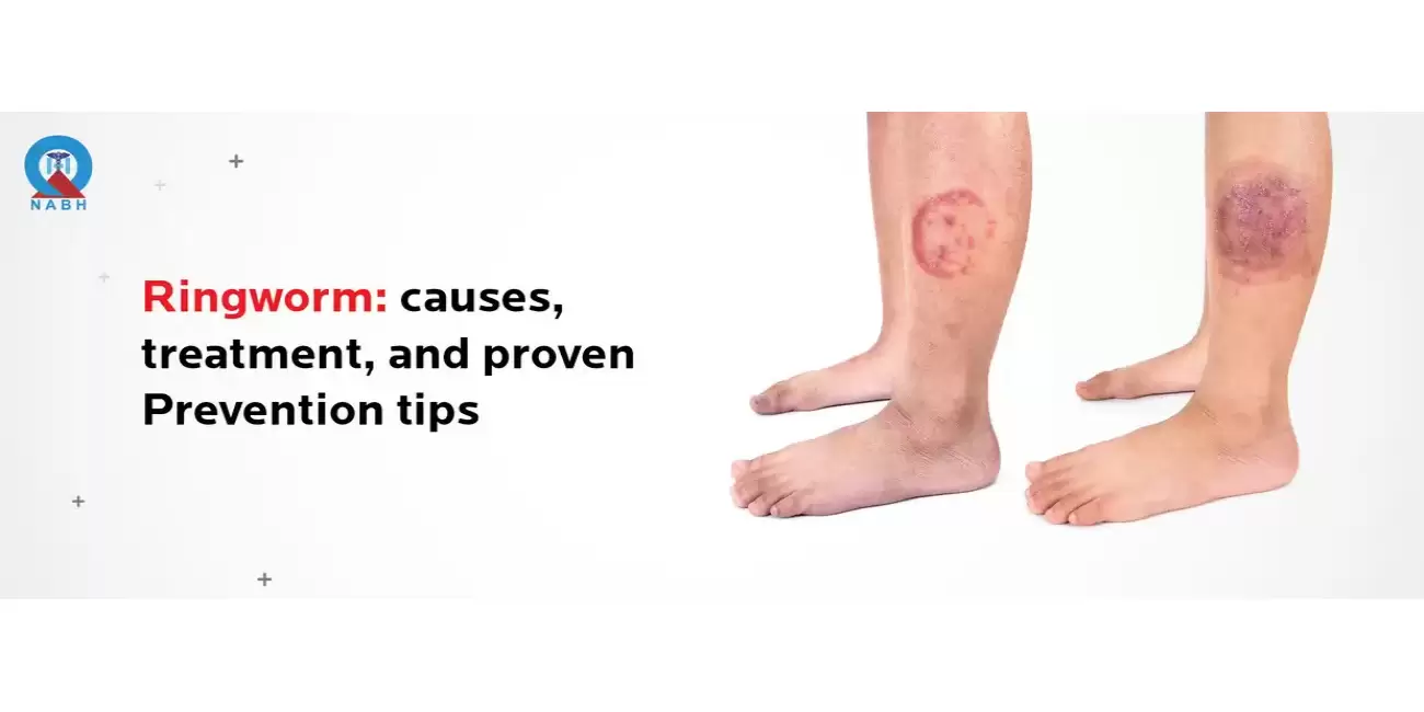 Ringworm Symptoms Causes Treatment Options RBH