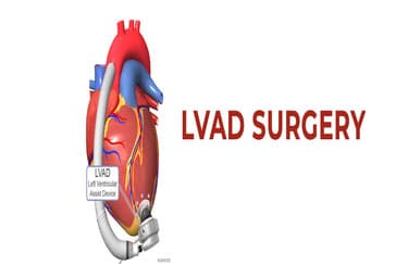 LVAD Surgery: Bridge to Transplant