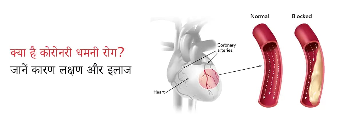 कोरोनरी धमनी रोग के कारण, लक्षण और उपचार