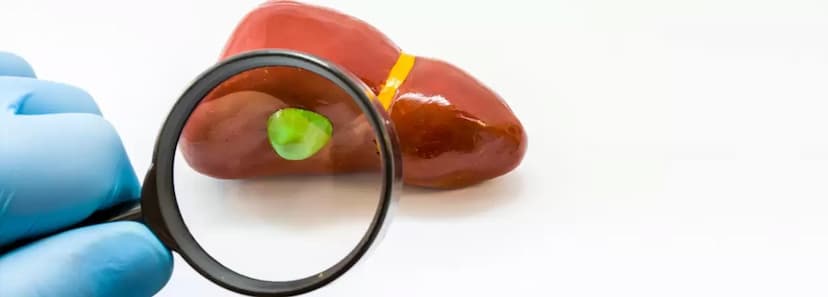 Everything one needs to know about Gallstones