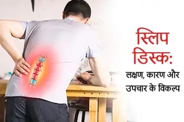 स्लिप डिस्क: लक्षण, कारण और उपचार के विकल्प