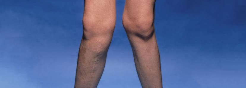 Knock Knees: Know The Treatment