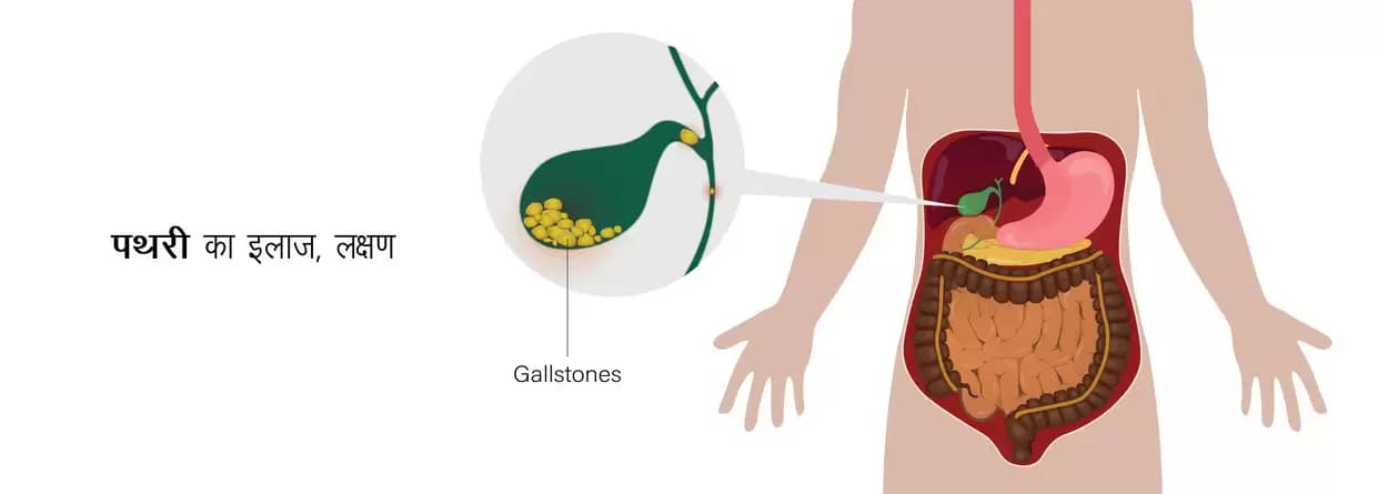 पथरी (Stone) - प्रकार, कारण, लक्षण और उपचार