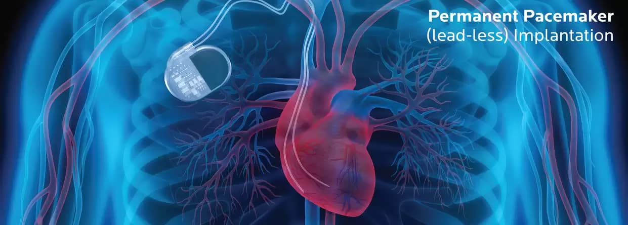 Permanent Pacemaker (Lead-Less) Implantation