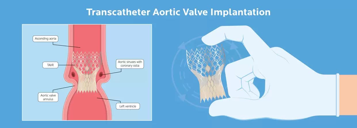 Transcatheter Aortic Valve Implantation