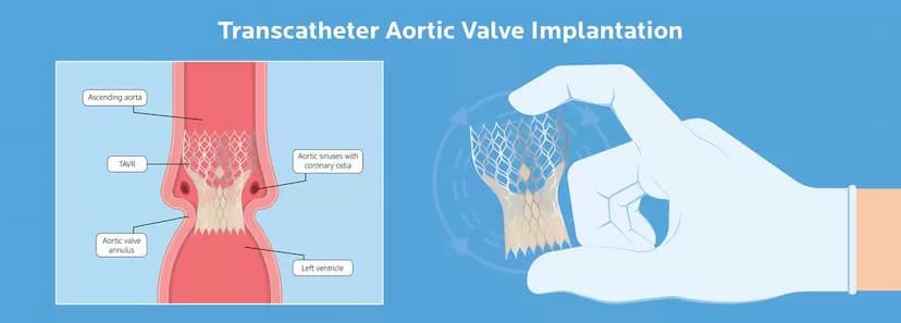 Transcatheter Aortic Valve Implantation