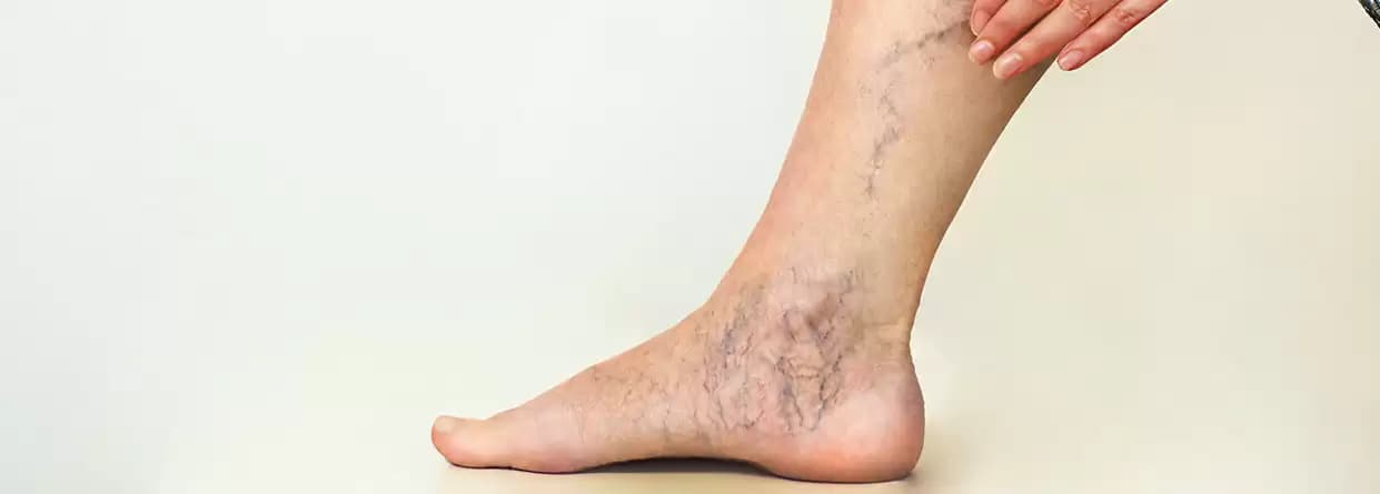 All You Need to Know About Varicose Veins and Your Surgical Options