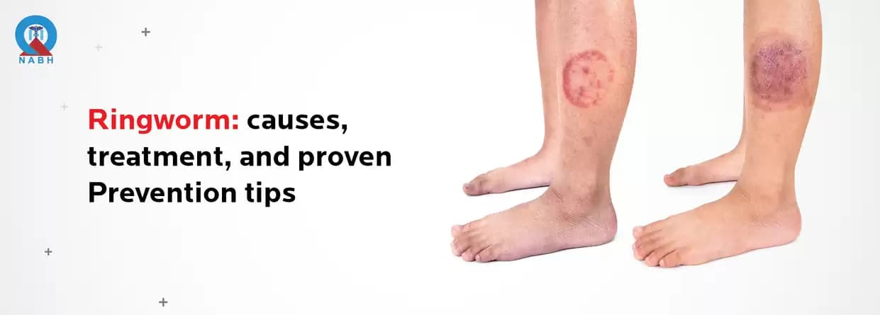 Ringworm: Symptoms, Causes, & Treatment Options