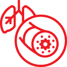 Bronchiectasis