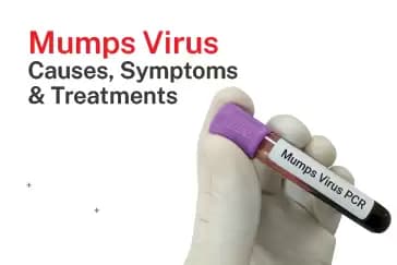 Mumps Virus: Causes, Symptoms & Treatments