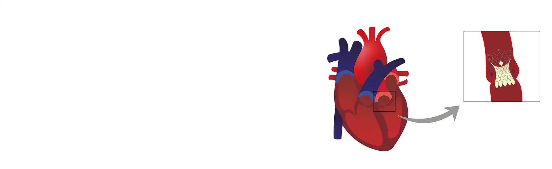 TAVR/TAVI Surgery