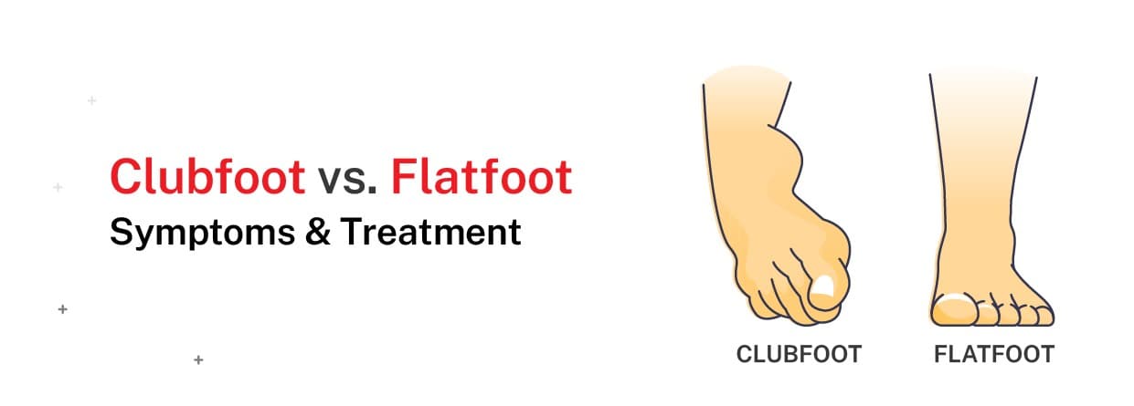 Clubfoot vs. Flatfoot: Symptoms & Treatment