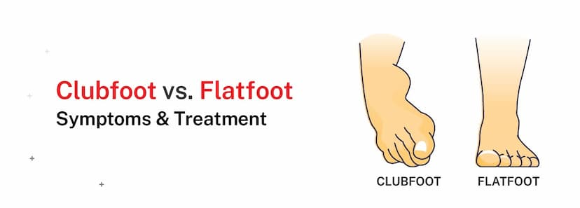 Clubfoot vs. Flatfoot: Symptoms & Treatment