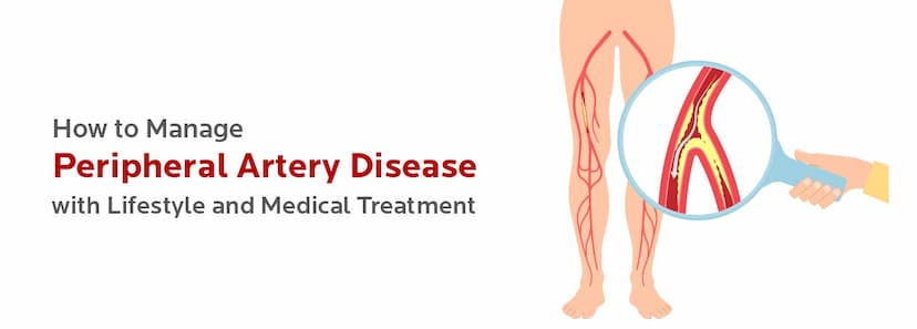 How to Manage Peripheral Artery Disease with Lifestyle and Medical Treatment