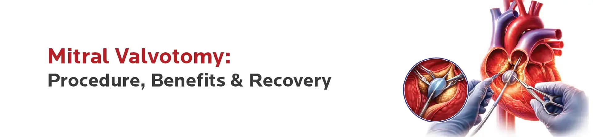 Mitral Valvotomy: Procedure, Benefits & Recovery