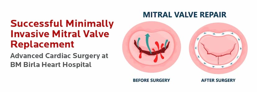 Successful Minimally Invasive Mitral Valve Replacement