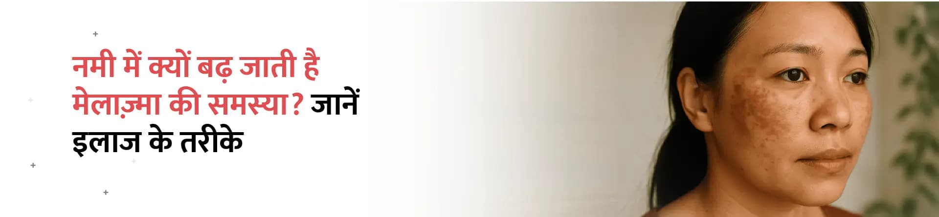 नमी में क्यों बढ़ जाती है मेलाज़्मा की समस्या? जानें इलाज के तरीके