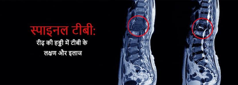 स्पाइनल टीबी: रीढ़ की हड्डी में टीबी के लक्षण और इलाज
