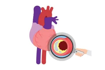Coronary Calcium Scan: The Test That Predicts Heart Attacks Before They Happen