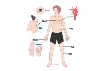 Marfan Syndrome & Heart Health: Understanding the Cardiovascular Impact