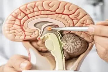 Successful Microsurgical Removal of a Third Ventricular Colloid Cyst Causing Hydrocephalus