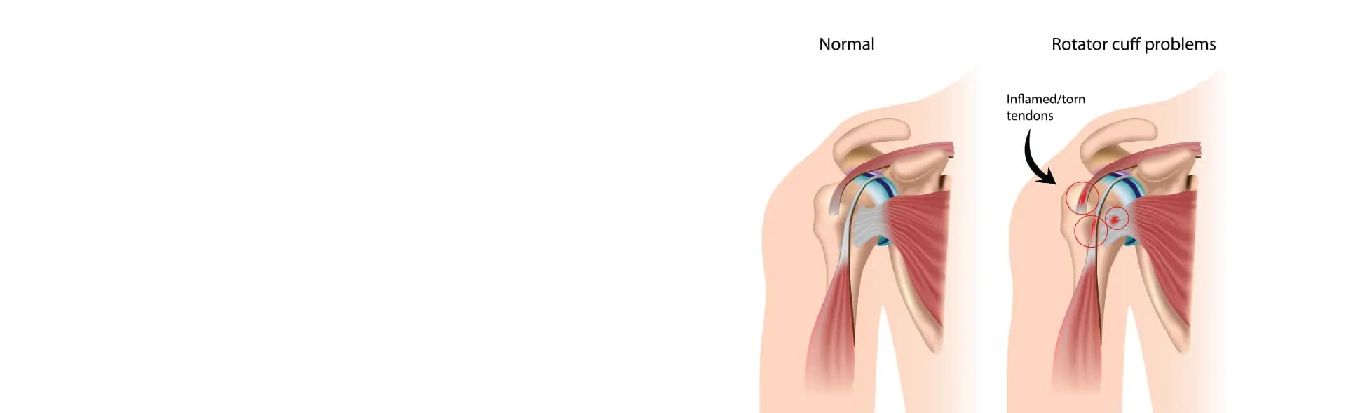 Rotator cuff injury