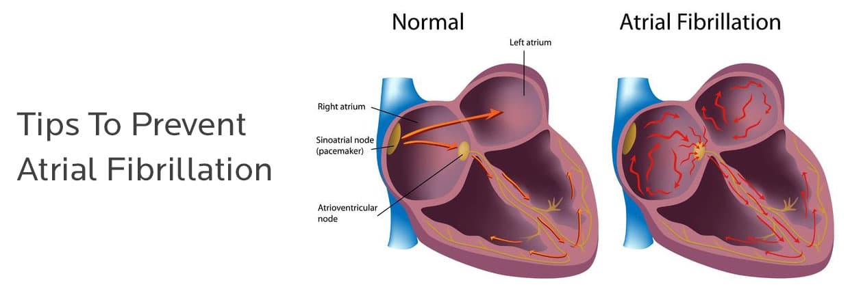 Tips To Prevent Atrial Fibrillation