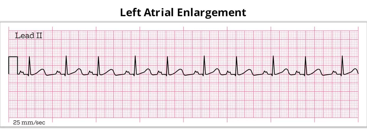 What You Must Know About Left Atrial enlargement?