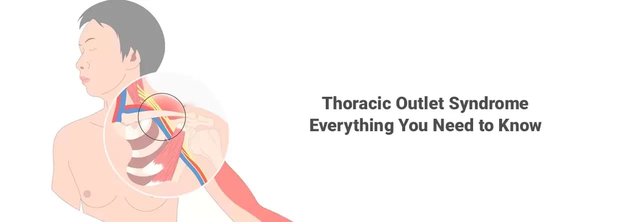 Thoracic Outlet Syndrome - Everything You should Know