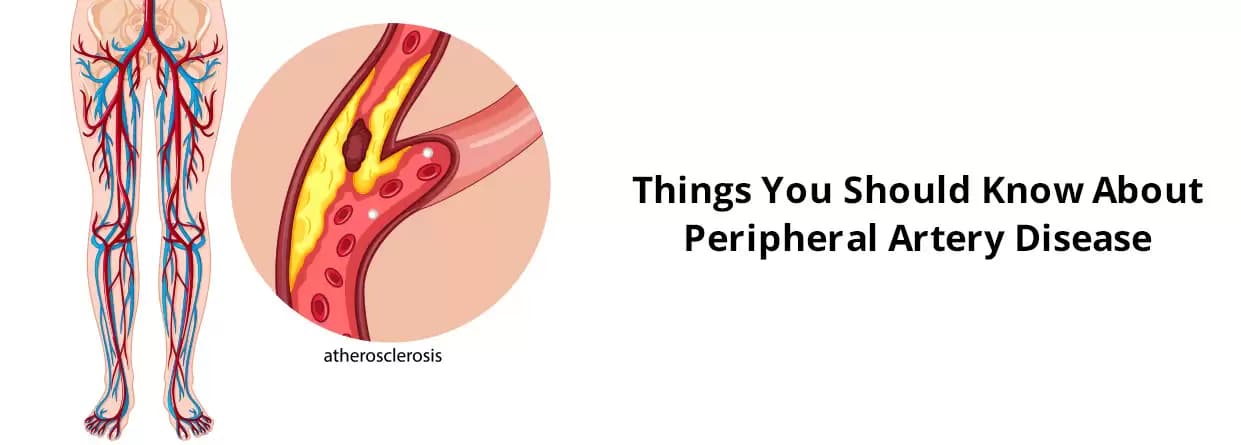 Things You Should Know About Peripheral Artery Disease