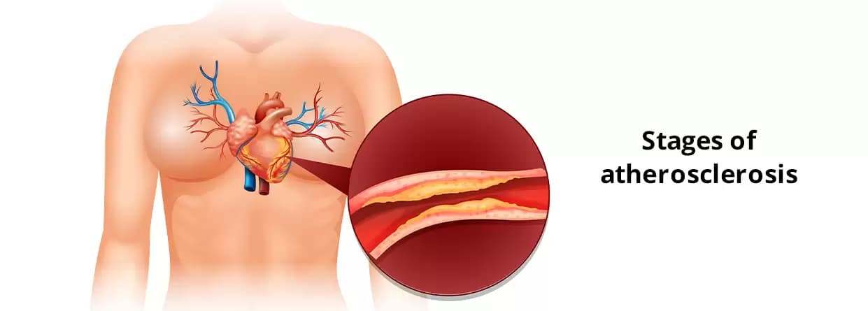 Everything You Need to Know about Atherosclerosis