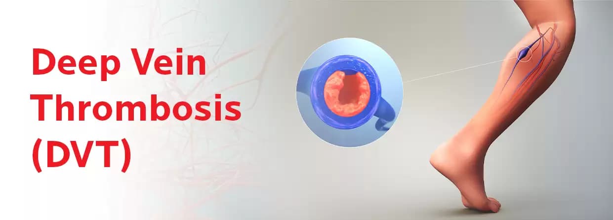 Everything You Need to Know About Deep Vein Thrombosis