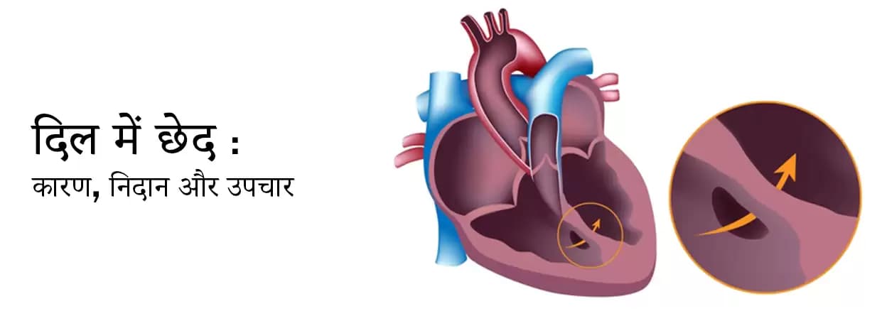 दिल में छेद (जन्मजात हृदय रोग) के कारण और जोखिम कारक