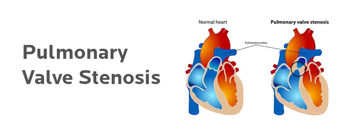 A Comprehensive Guide to Pulmonary Valve Stenosis