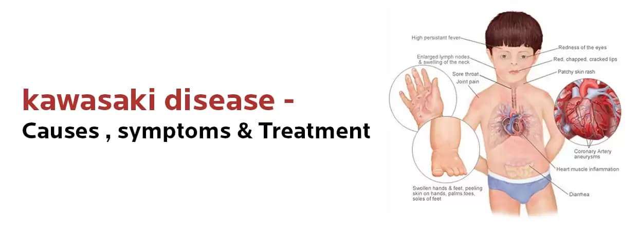 Everything You Need to Know About Kawasaki Disease