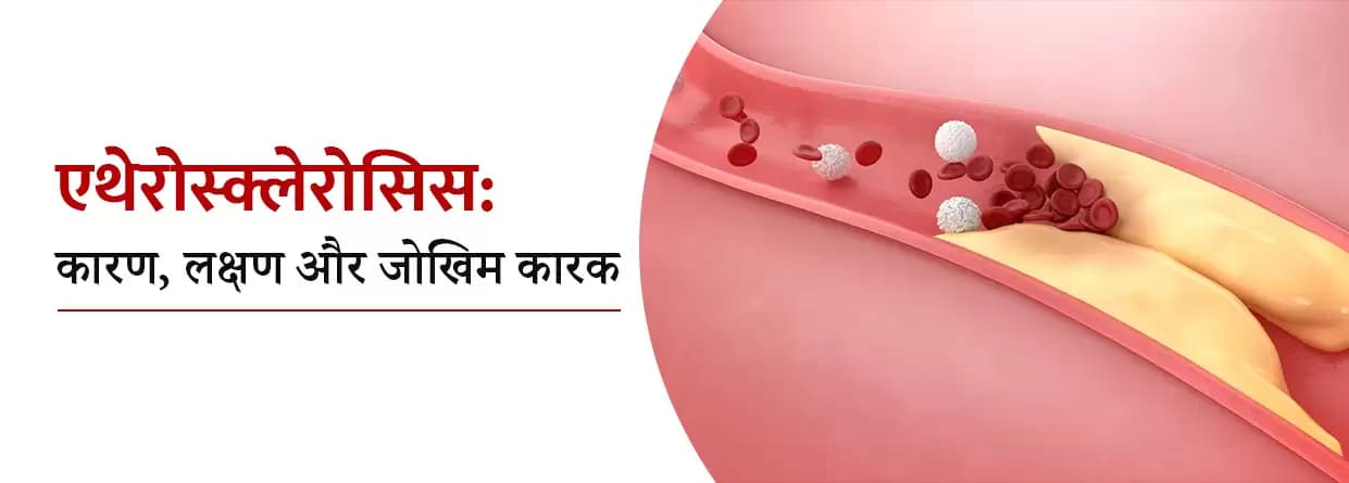 एथेरोस्क्लेरोसिस: कारण, लक्षण और जोखिम कारक