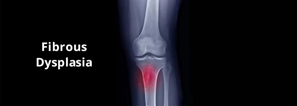 Fibrous Dysplasia: Things You Need To Know