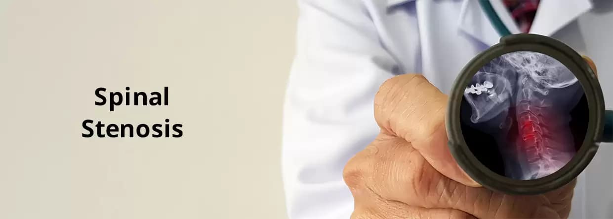 Spinal Stenosis: Things You Should Know