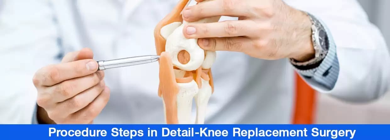 Procedure Steps in Detail-Knee Replacement Surgery