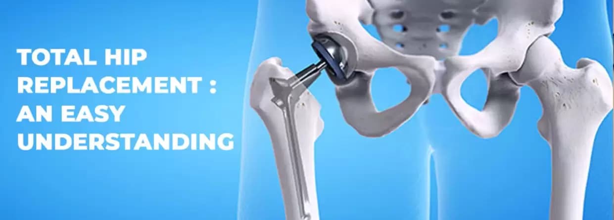 Total hip replacement: An easy understanding