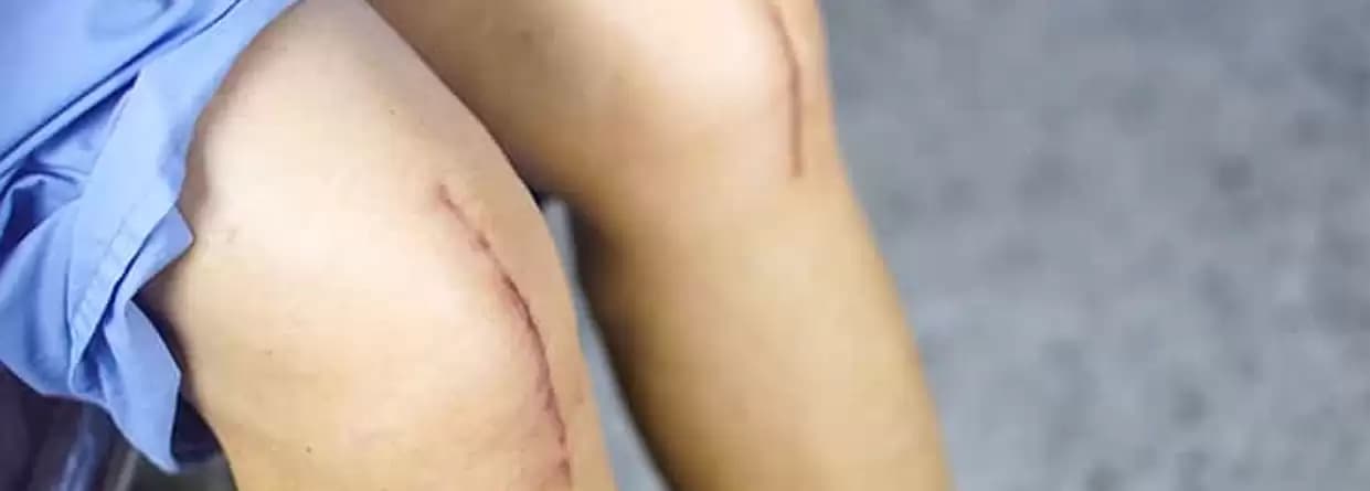 Knee replacement surgery