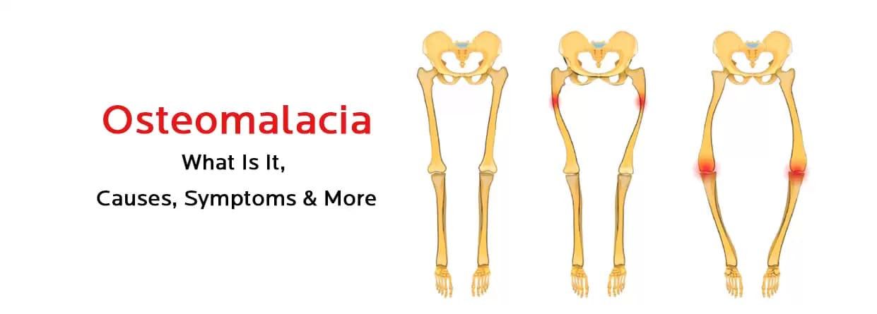 Osteomalacia - What Is It, Causes, Symptoms, & Treatment