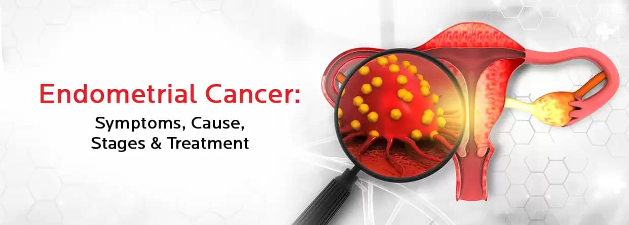 Endometrial Cancer - Your Ultimate Guide