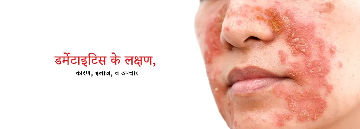 डर्मेटाइटिस: जानिए इसके कारण, लक्षण और उपचार