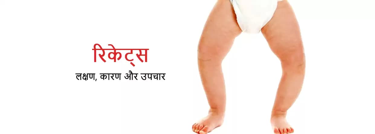 रिकेट्स: लक्षण, कारण और उपचार