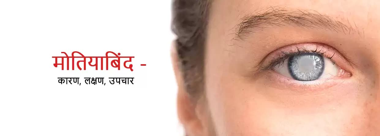 मोतियाबिंद - कारण, लक्षण, और उपचार