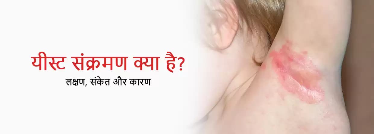 यीस्ट संक्रमण क्या है? - लक्षण, कारण और इलाज