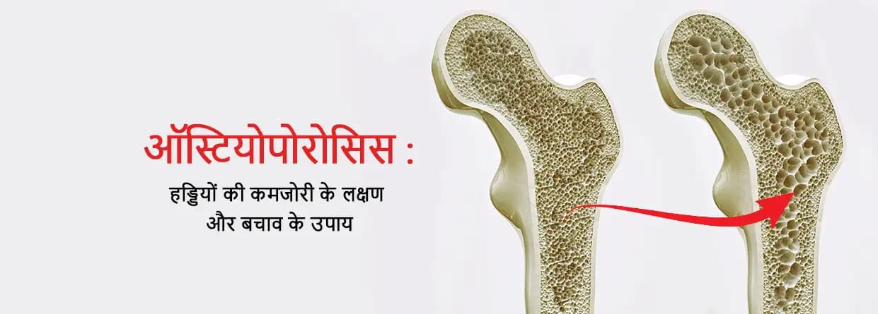 ऑस्टियोपोरोसिस: हड्डियों की कमजोरी के लक्षण और बचाव के उपाय