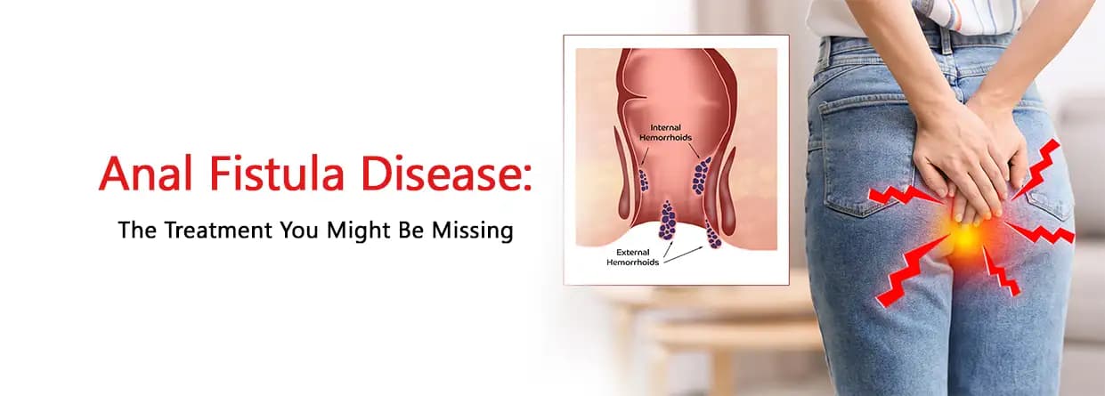 Anal Fistula Disease: The Treatment You Might Be Missing