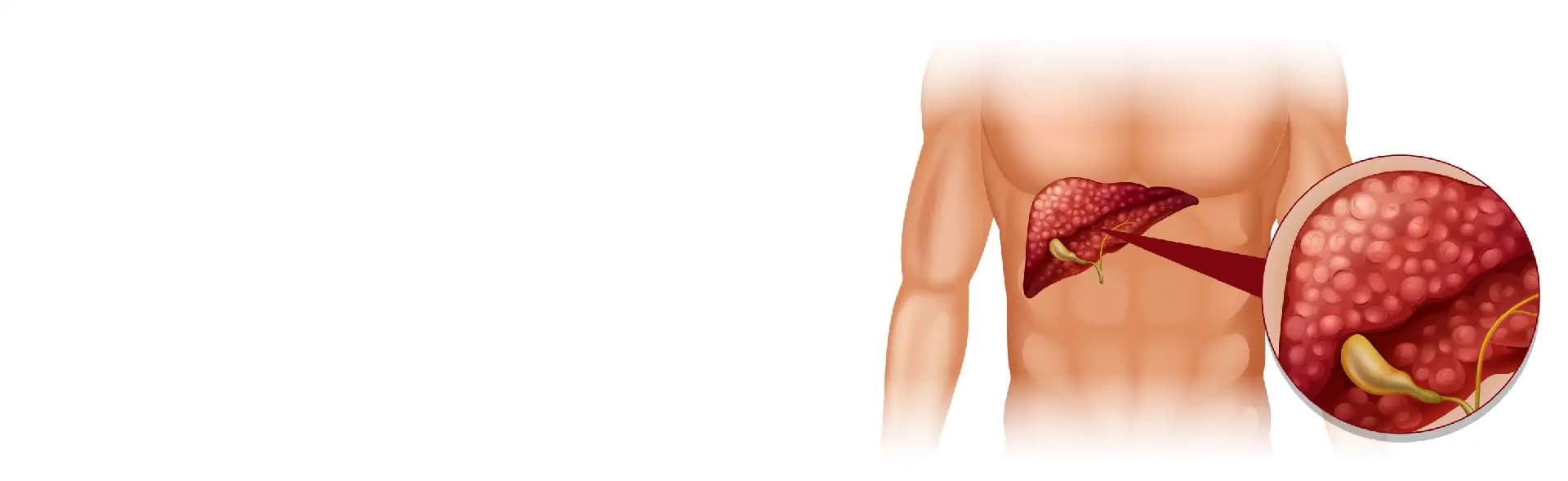 Gallbladder Removal Surgery